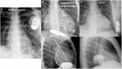 Management of hemodynamically stable wide QRS complex tachycardia in patients with implantable cardioverter defibrillators